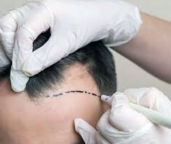 Who Is the Right Candidate for a Hair Transplant?